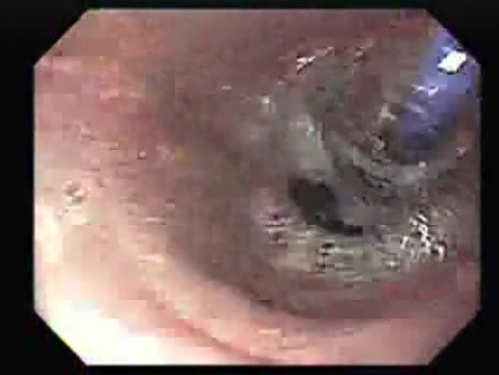 Achalasia Residual Food (5 of 11)