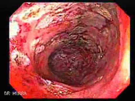 Post-Radiation Colitis (11 of 13)