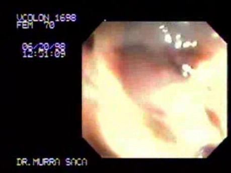 Enterorrhagia (1 of 2)