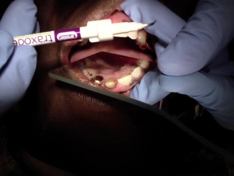Crown Tryin - Gingival Collapse - What Would You Do?