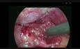 Lap Cholecystectomy - CVS Technique