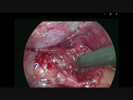 Lap Cholecystectomy - CVS Technique