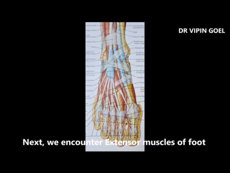 Foot Amputation for Malignant Melanoma Sole (Lisfranc Amputation)