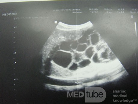 Liver hydatid cyst - Abdominal US