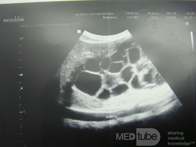Liver hydatid cyst - Abdominal US