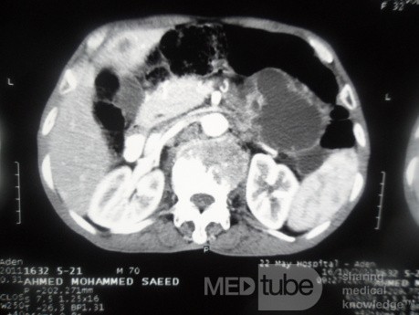 Pancreas cancer - 4