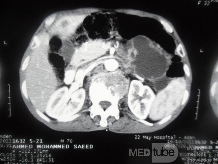 Pancreas cancer - 4