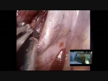 Non Intubated Complete Paratracheal Lymph Node Dissection