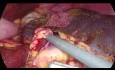 Laparoscopic Splenectomy in a Patient with Agenesis of the Dorsal Pancreas - Vessels First Technique