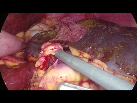 Laparoscopic Splenectomy in a Patient with Agenesis of the Dorsal Pancreas - Vessels First Technique