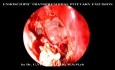 Endoscopic Transphenodial Pitutary Excision