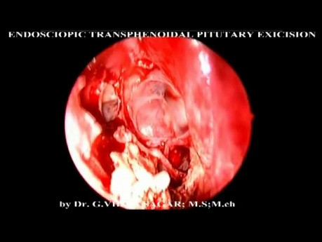Endoscopic Transphenodial Pitutary Excision