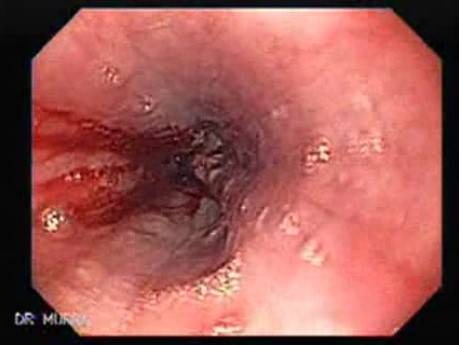 Gastric Adenocarcinoma That Has Been Manifested With Hiccups (5 of 5)