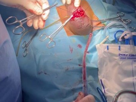 Fibrosis of Cavernous Body