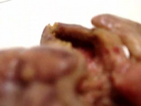 Toxic Dilatation Of The Colon Superimposed Pseudomembranous Colitis (12 z 17)