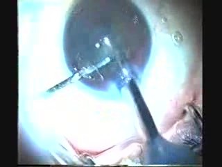 Phacoemulsification