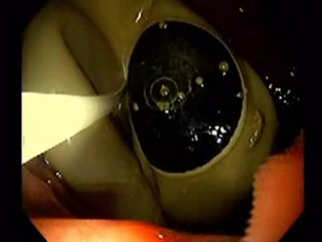 Endoscopic Balloon Removal (3 of 9)