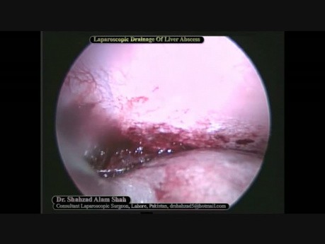 Laparoscopic Drainage of Liver Abscess
