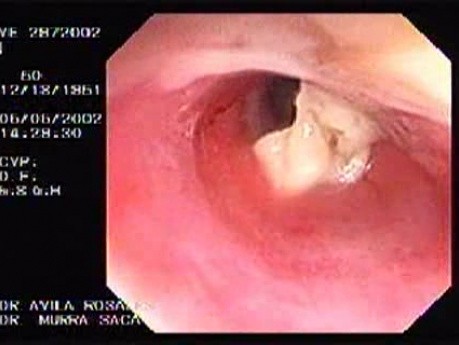 Zollinger- Ellison Syndrome - Gastric Ulcer with Gastrocolic Fistula (9 of 21)