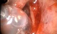 Lumina Light Cable - Device for Maxillary Balloon Sinuplasty