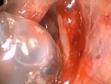Lumina Light Cable - Device for Maxillary Balloon Sinuplasty