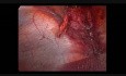 Umbilical Hernia and Diastasis Recti