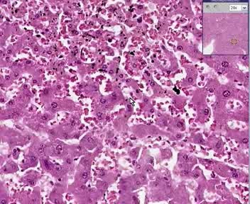 Lung And Liver- Congestion And Hemorrhage