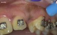Step by Step Surgical Exposure and Orthodontic Traction of Impacted Canine