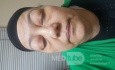 Mixed Graves' Orbitopathy and Ocular Myasthenia Gravis, a Rare Condition 