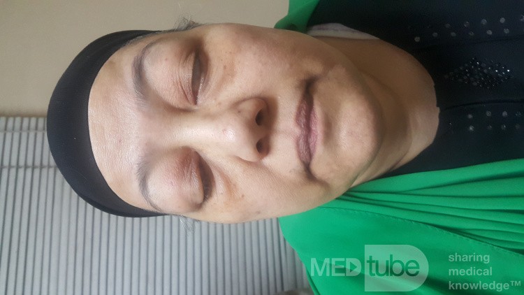 Mixed Graves' Orbitopathy and Ocular Myasthenia Gravis, a Rare Condition 