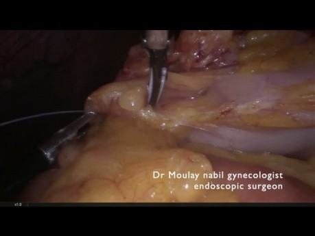 Infracolic omentectomy