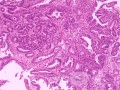 Adenocarcinoma of the middle third (5 of 5 )