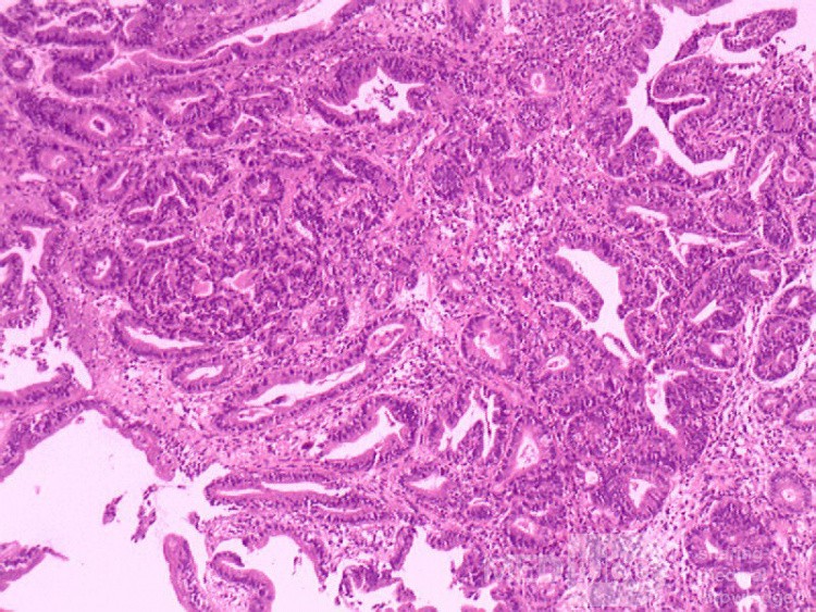 Adenocarcinoma of the middle third (5 of 5 )