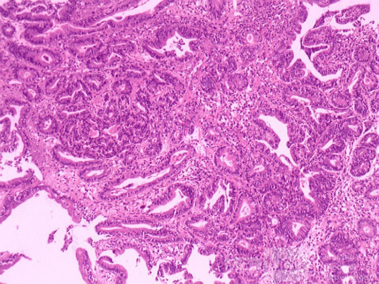 Adenocarcinoma of the middle third (5 of 5 )