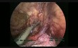 Laparoscopic Left Colectomy, Step By Step