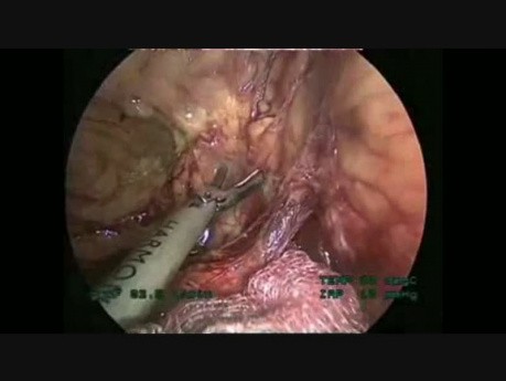 Laparoscopic Left Colectomy, Step By Step
