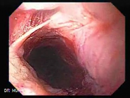 Perforation of a Esophageal Carcinoma after the procedure with hydrostatic balloon dilation (1 of 12)
