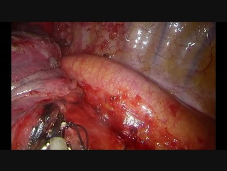 Uniportal Vats Double Anatomic Ipsilateral Segmentectomy S3 and S9-10