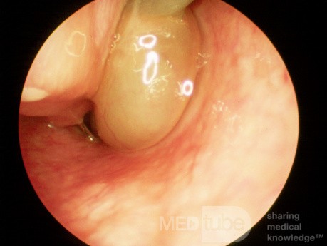 Left Antrochoanal Polyp 2