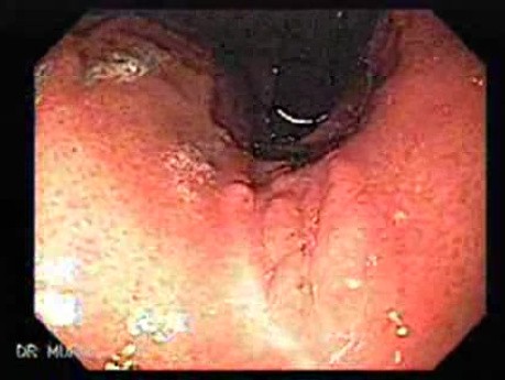 Hyperplastic Polyp - Endoscopy (4 of 8)
