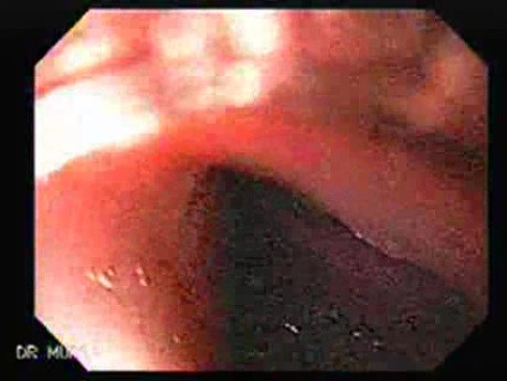 Non-Hodking Lymphoma - Presentation of the Lesions, Part 2
