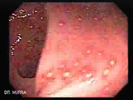 Endoscopic Image of Amebiasis Colitis