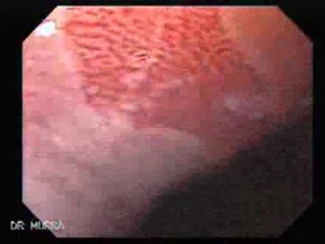 Barrett's Esophagus of long segment (8 of 24)