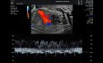 Ductus Venosus Doppler