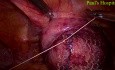 Laparoscopic Pelvic Prolapse Surgery 