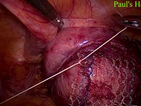 Laparoscopic Pelvic Prolapse Surgery 