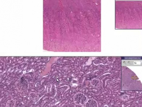 Nephrocalcinosis - Histopathology - Kidney