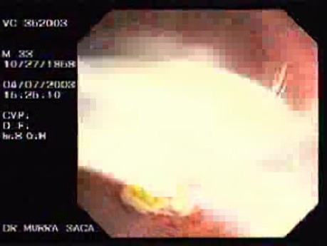 Endoscopic View of Amebiasis Colitis (3 of 7)