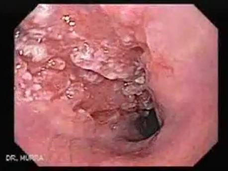 Esophageal Squamous Cell Carcinoma (1 of 2 )