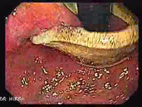 Penetration of Adjustable Laparoscopic Gastric Banding (3 of 4)